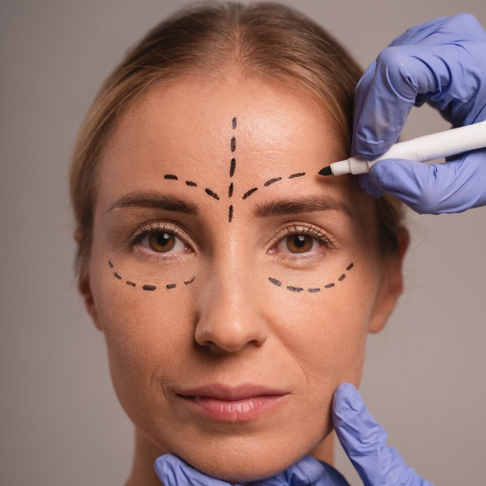 endoscopic brow lift alessi