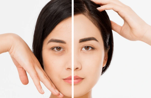 endoscopic brow lift alessi cosmetics