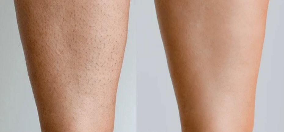 laser hair removal alessi cosmetic surgery