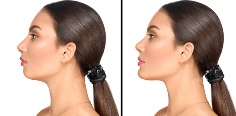 cheek and chin implant alessi cosmetic surgery