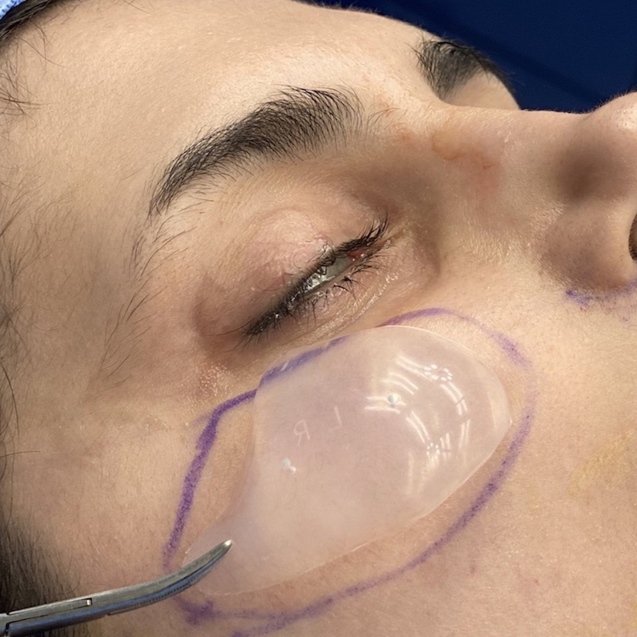 Alessi Cosmetic Surgery Cheek Implant