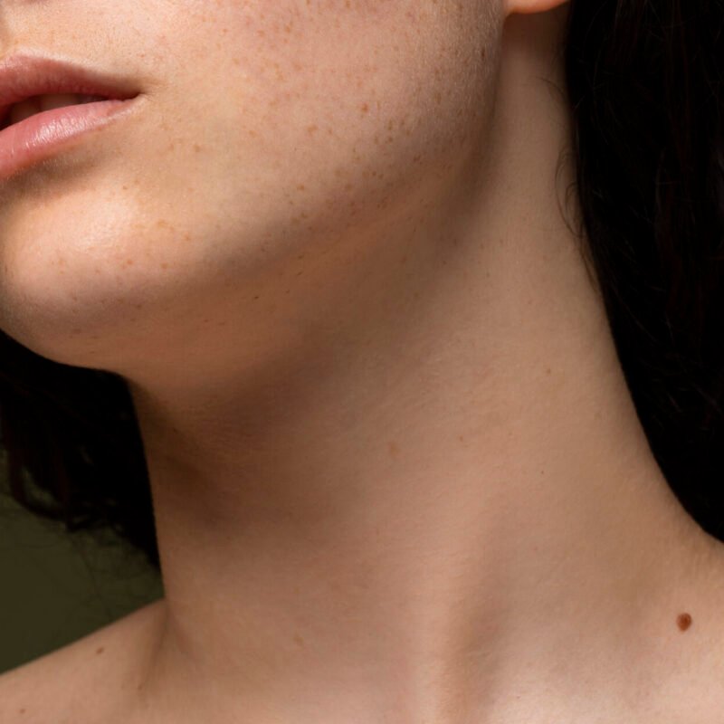 Lesion and Vein Removal Alessi Cosmetic Surgery