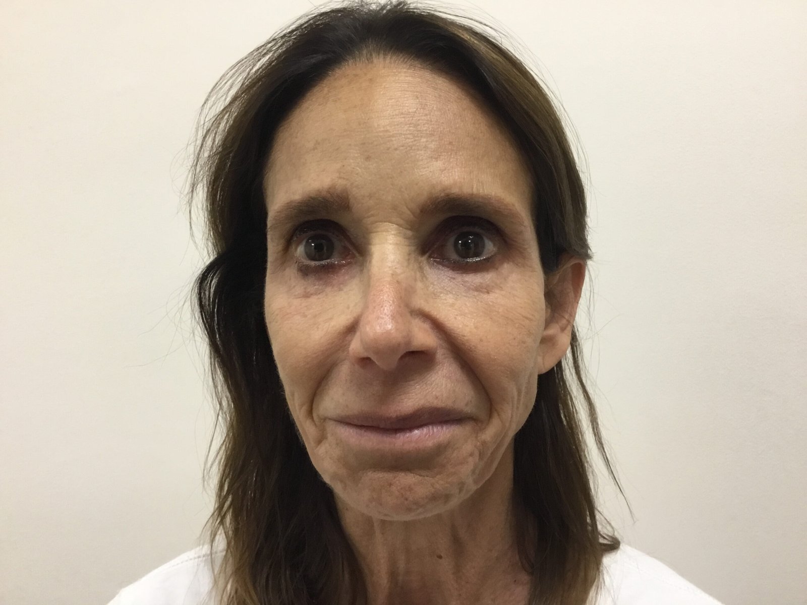 Donna R Post Cheek Filler 2A Restylane Defyne