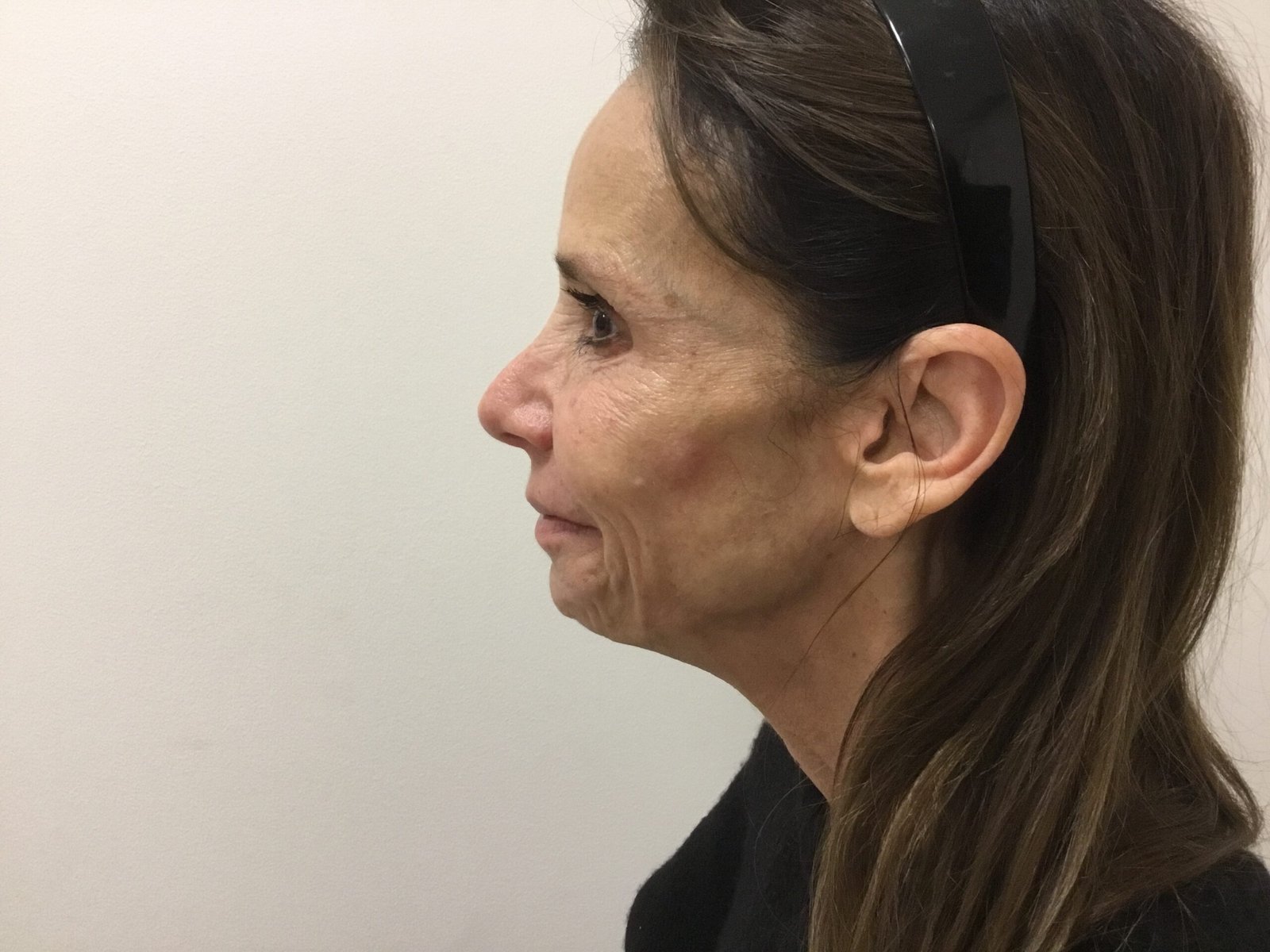 Donna R Post Cheek Filler 3A
