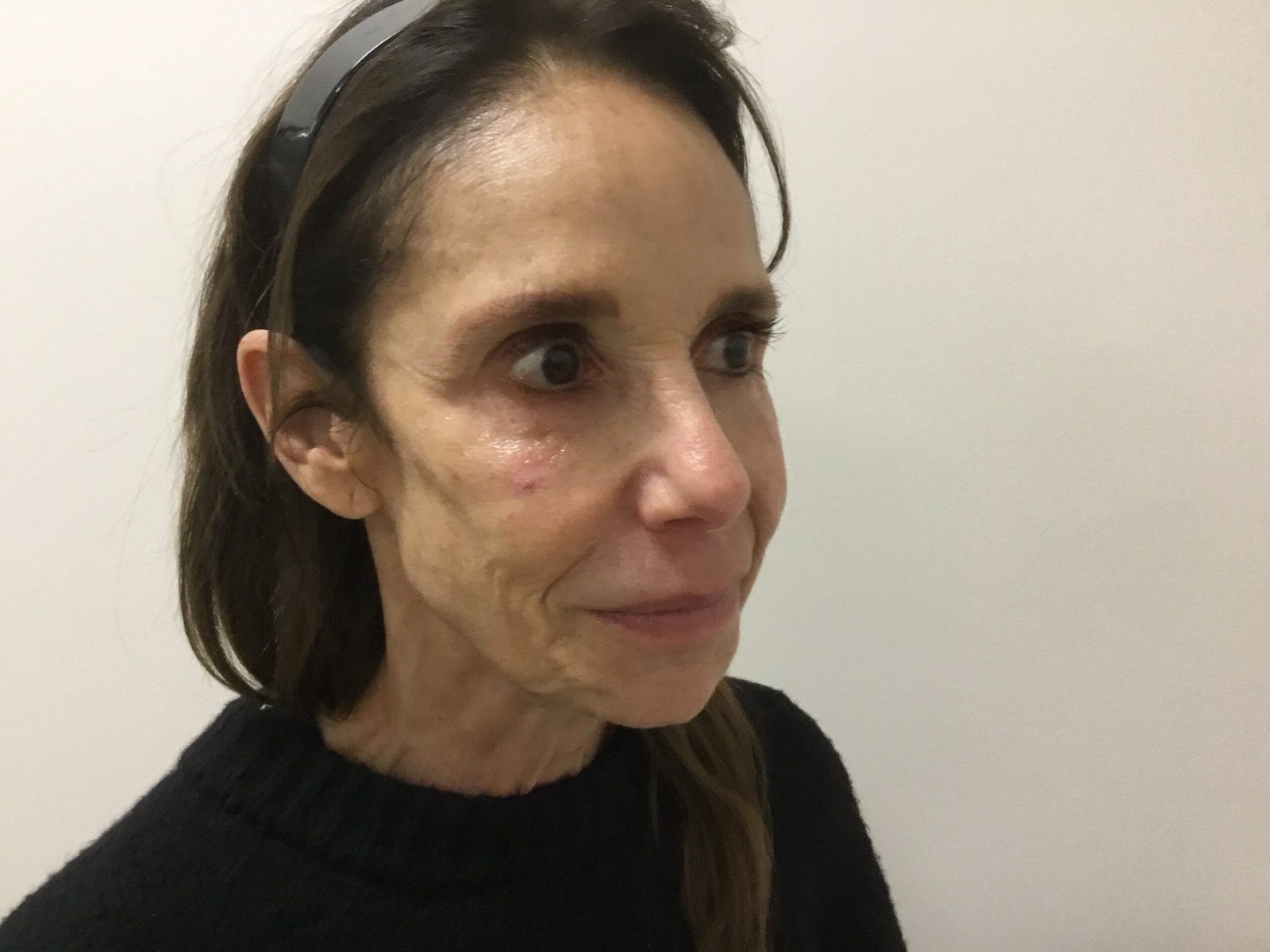 Donna R Post Cheek Filler