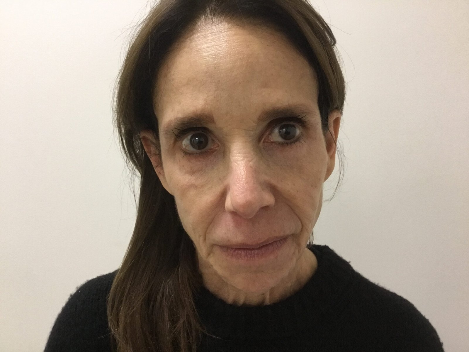 Donna R Pre Cheek Filler 2