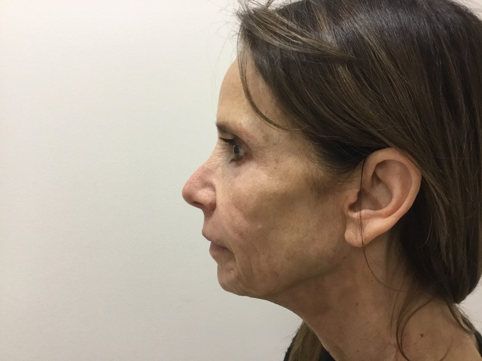 Donna R Pre Cheek Filler 3