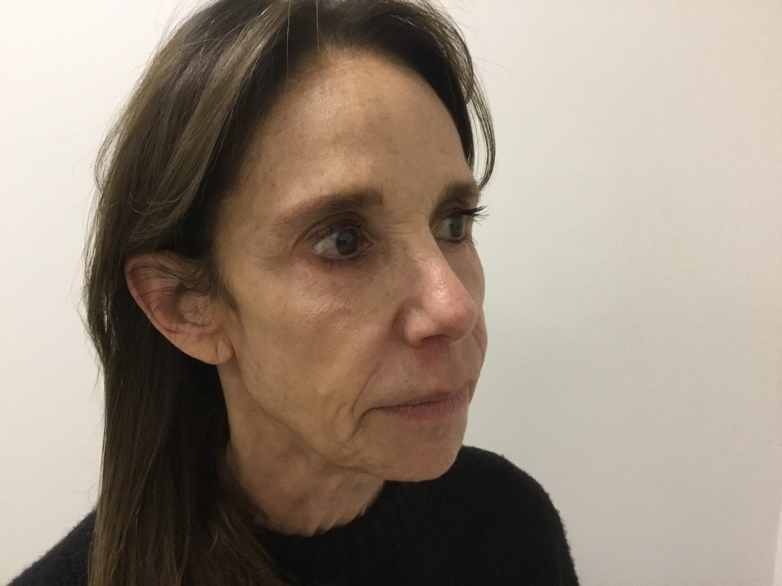 Donna R Pre Cheek Filler