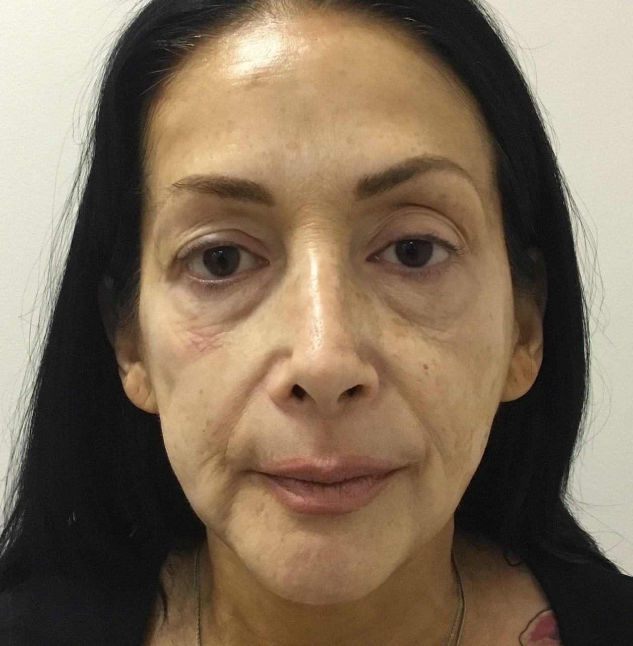 Before Blepharoplasty