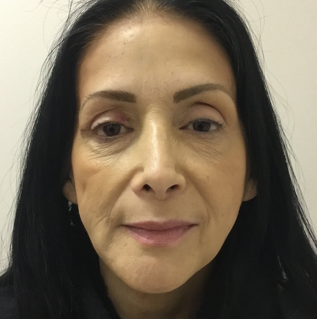 After Blepharoplasty