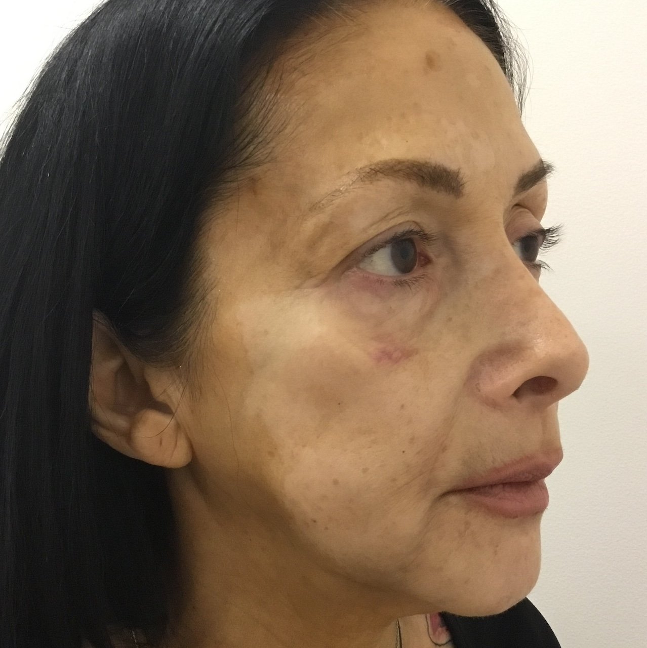 Before Blepharoplasty