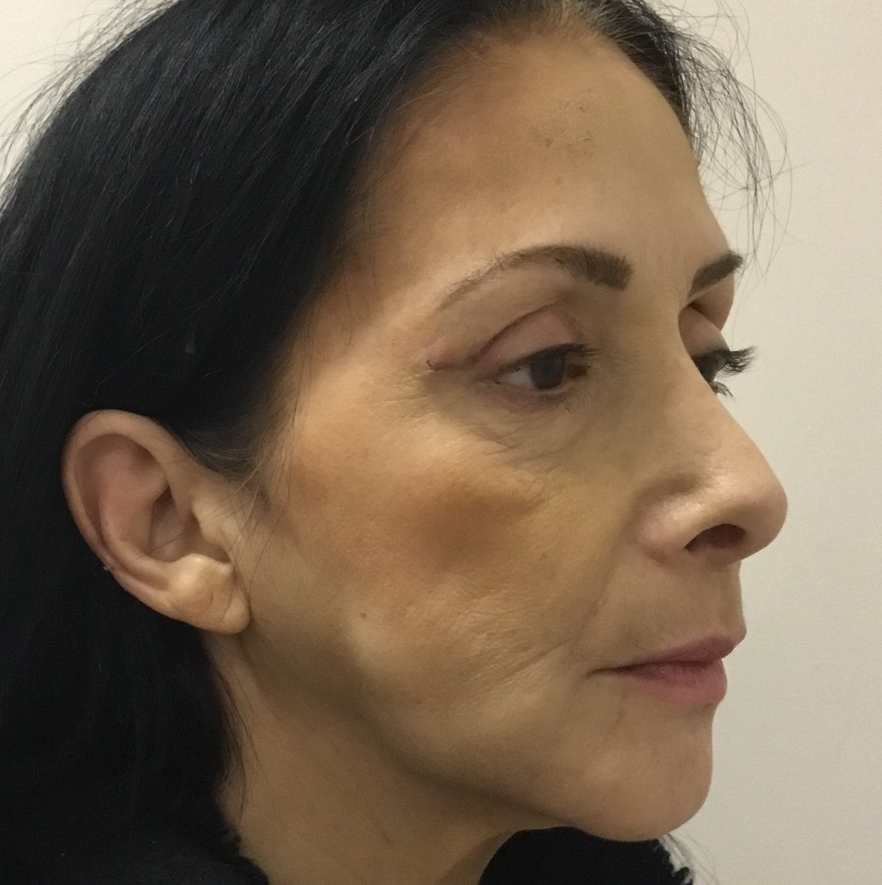 After Blepharoplasty