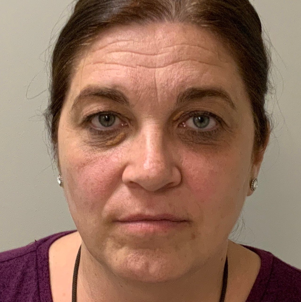 Before Blepharoplasty and Pinch Incision