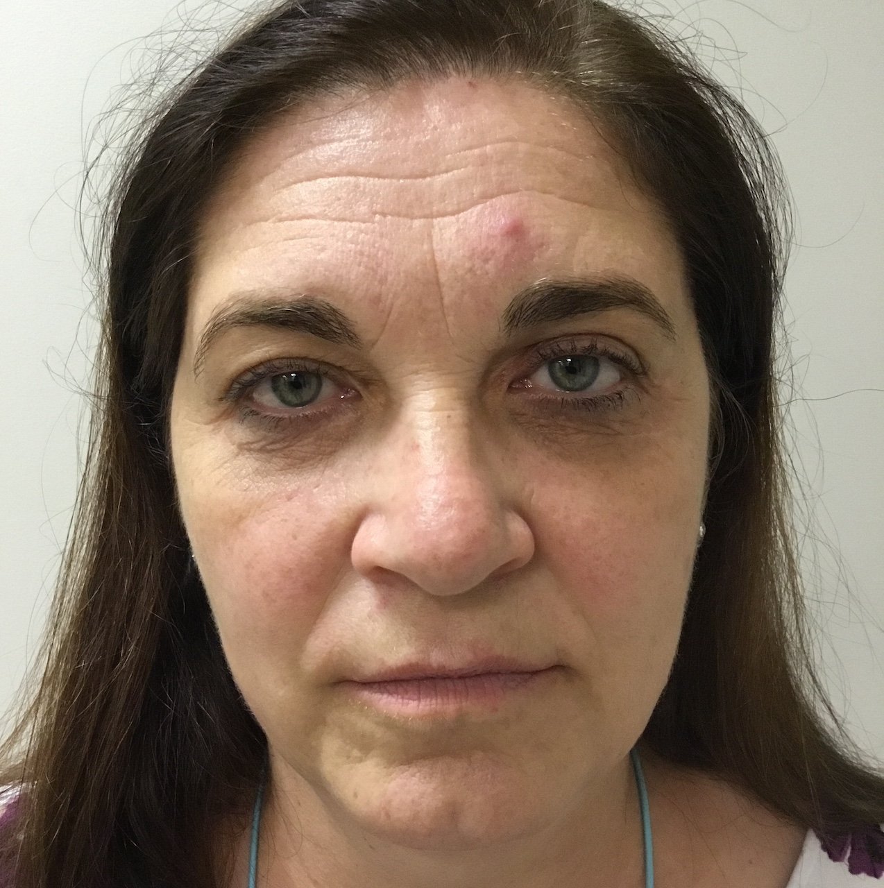 After Blepharoplasty and Pinch Incision
