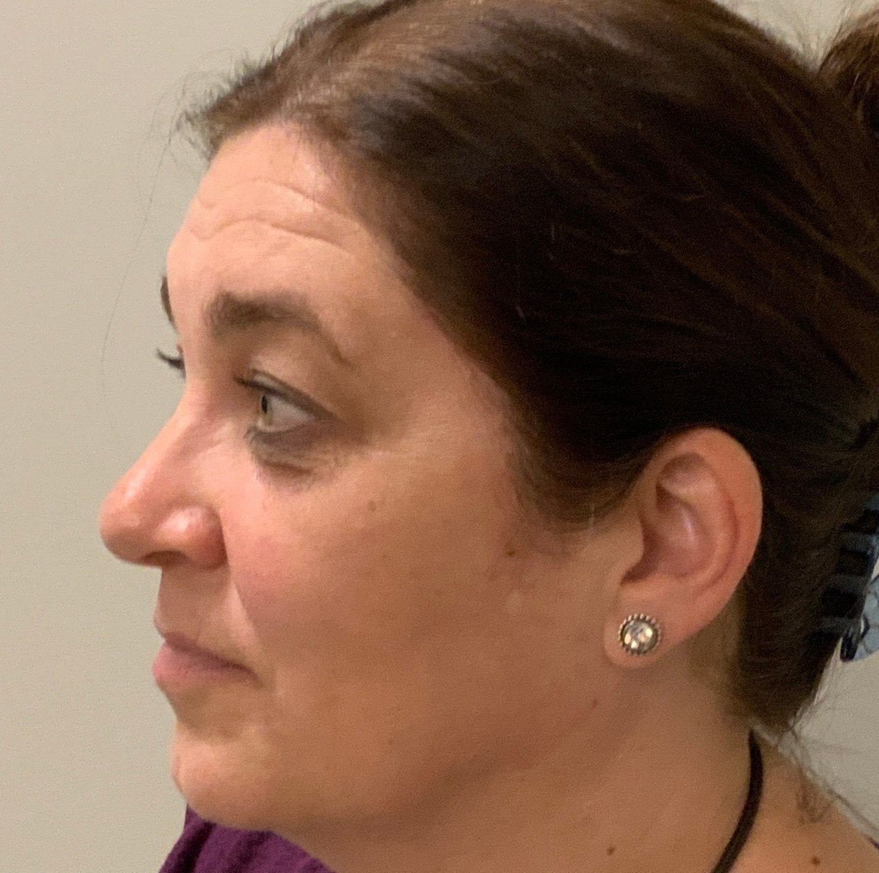 Before Blepharoplasty and Pinch Incision