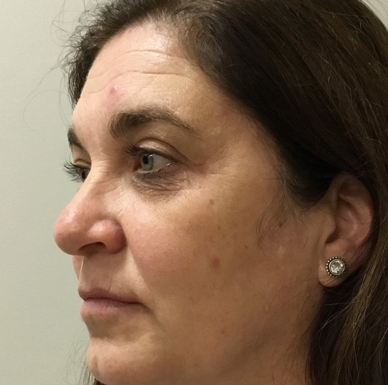 After Blepharoplasty and Pinch Incision